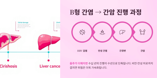 B형 간염이 간암으로 진행되는 과정