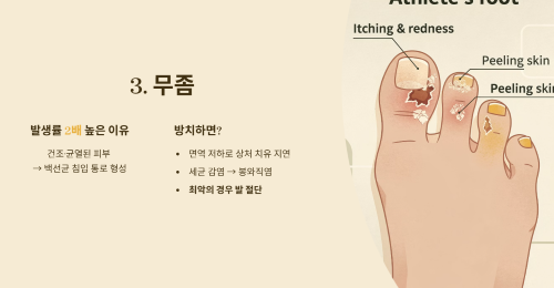무좀