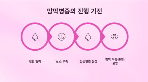 당뇨망막병증의 기전